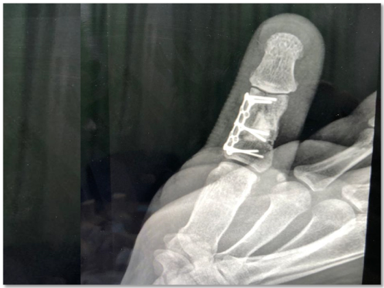 fractures-ligament-injuries